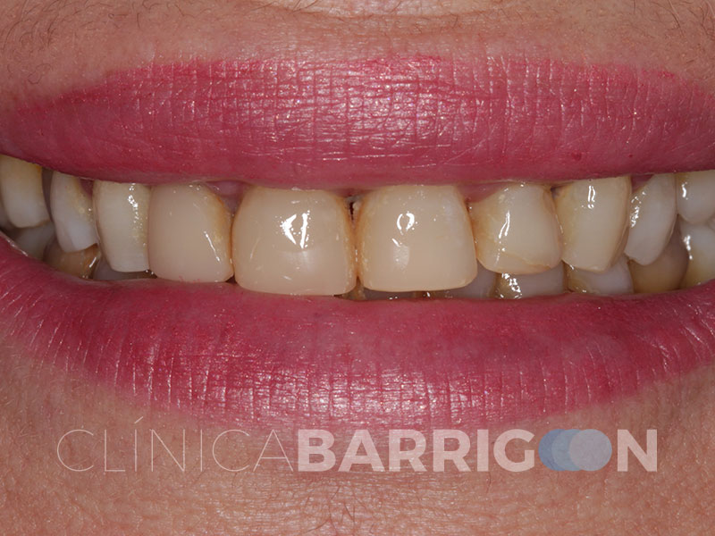 Caso de Carillas de Cerámica - Clínica Dental Barrigón