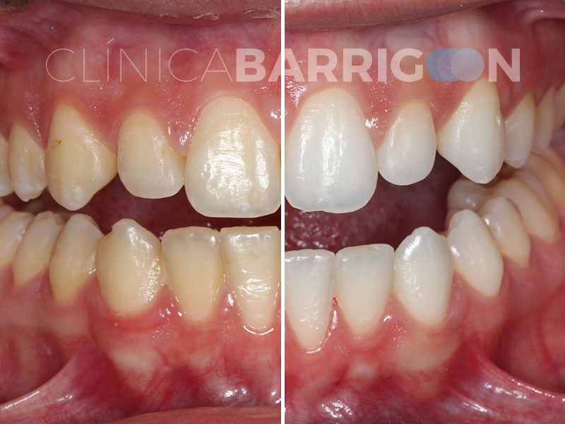 Caso de Blanqueamiento dental 3