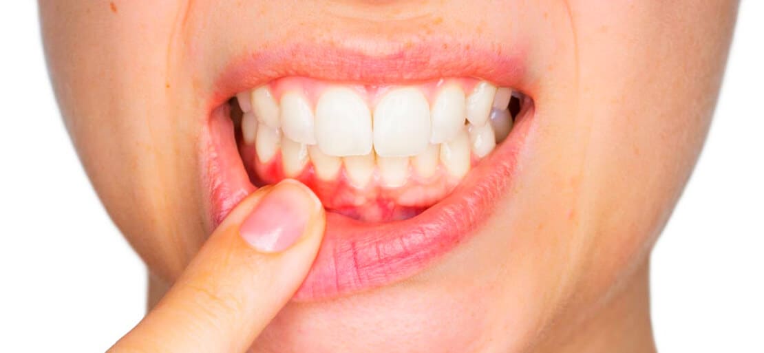 Qué es la gingivitis y cómo prevenirla