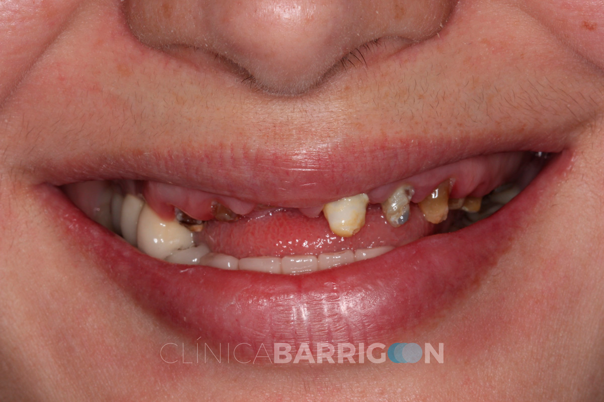 implantes-dentales-valladolid-3