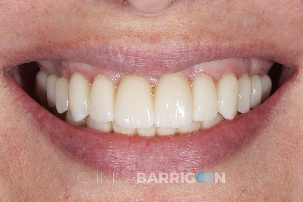 implantes-dentales-valladolid-7