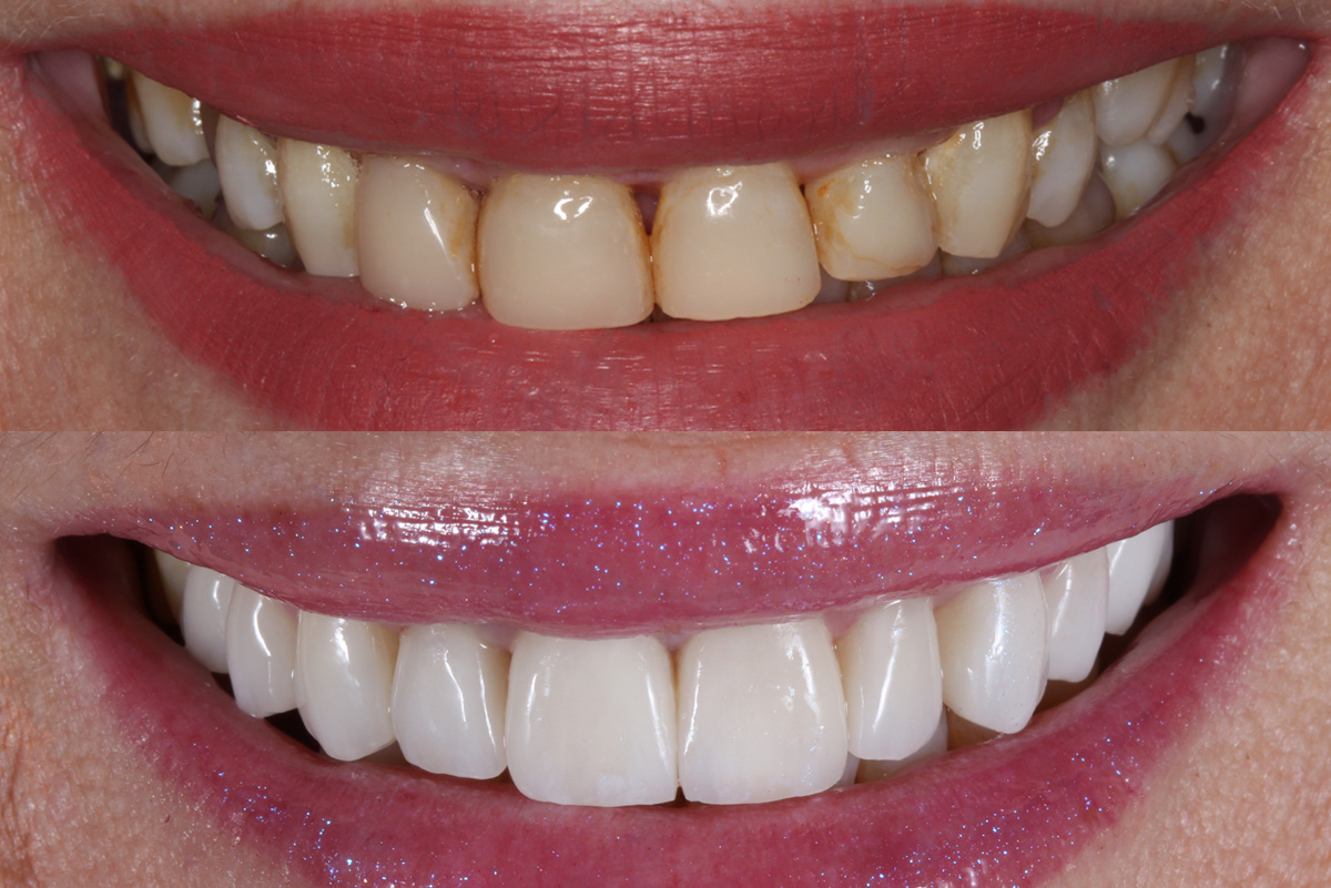 Carillas dentales: qué son, cuánto duran y si son para ti