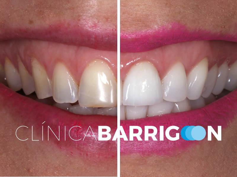 Caso de blanqueamiento y carillas