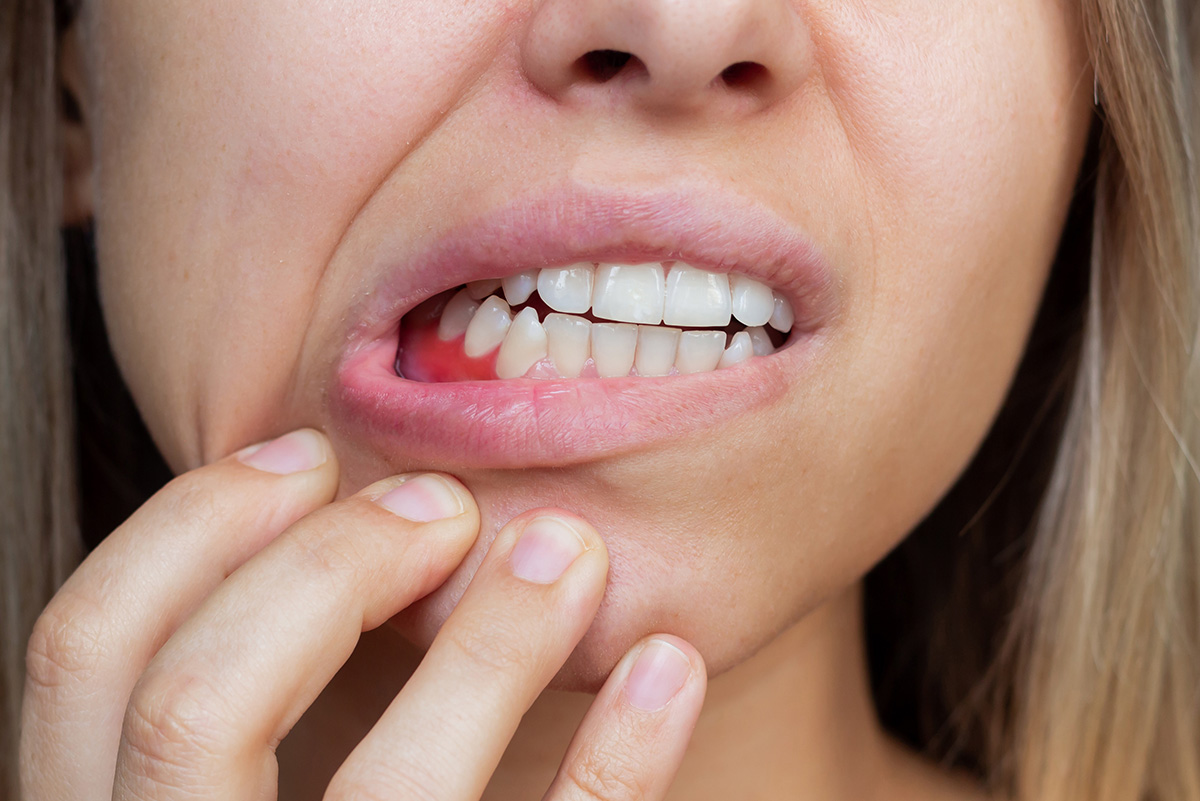 Curetaje dental: el tratamiento que salva tus encías