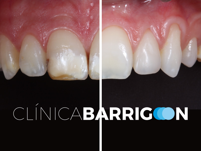 Caso de manchas blancas