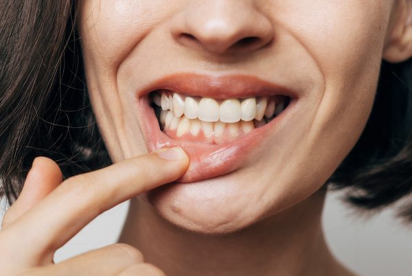 retraccion-encias-tratamiento-valladolid