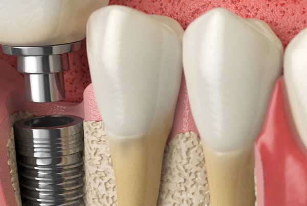 implantes-no-cicatrizan-bien