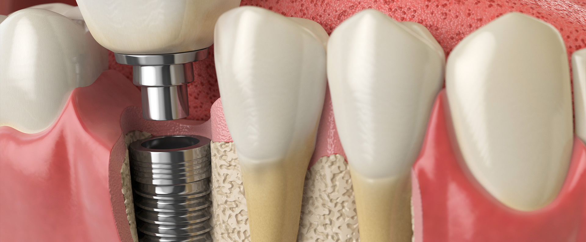 Por qué algunos implantes no cicatrizan bien: factores que condicionan el éxito