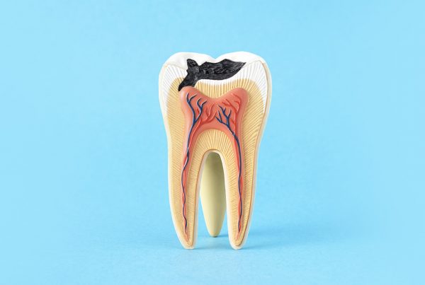 Que-pasa-si-ignoro-una-caries