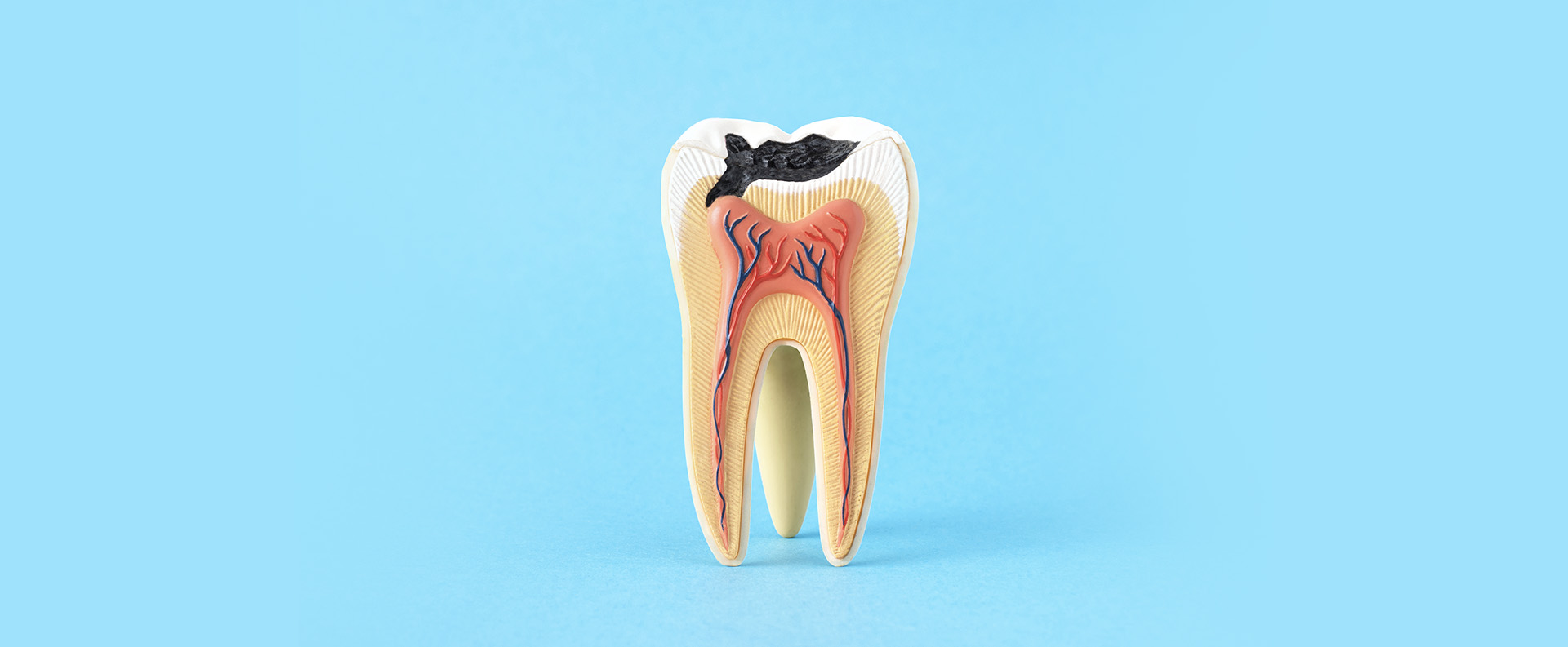¿Qué pasa si ignoro una caries? Consecuencias y tratamiento en Valladolid
