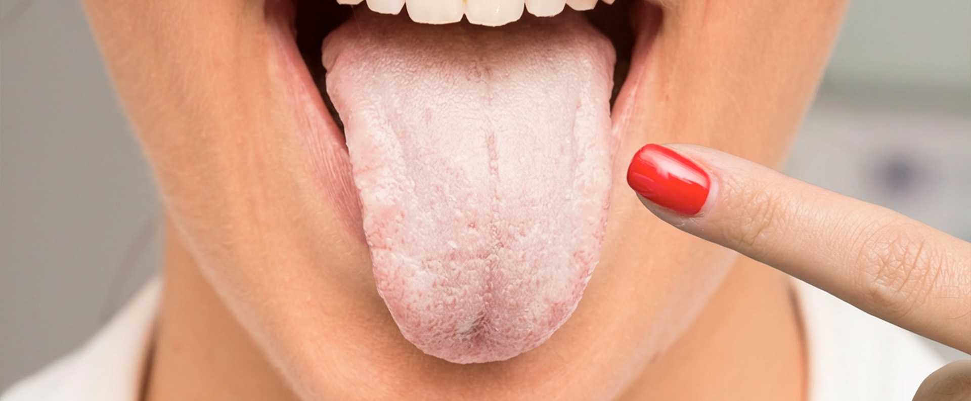 Lengua blanca al despertarse: causas más comunes y cuándo preocuparse