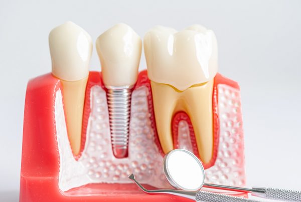 implantes-dentales-valladolid-clinica