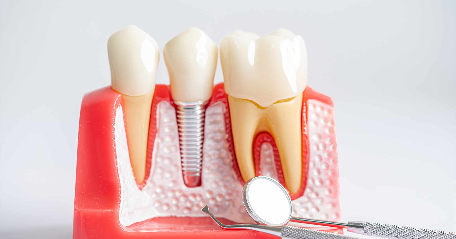 Implantes dentales en Valladolid: así trabajamos cada caso de forma personalizada