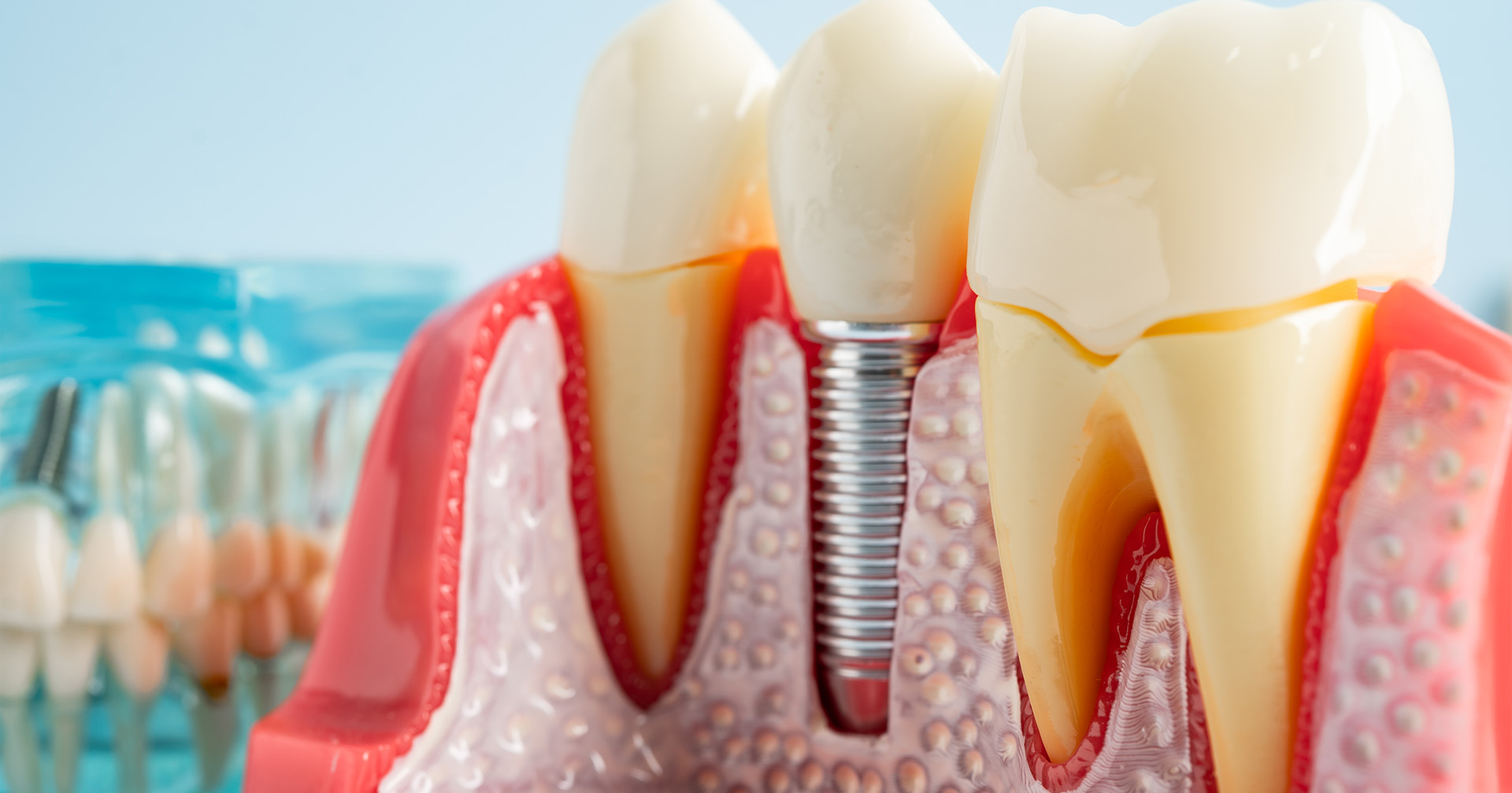 implantes-dentales-valladolid-clinica2