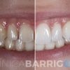 carillas-dentales-valladolid