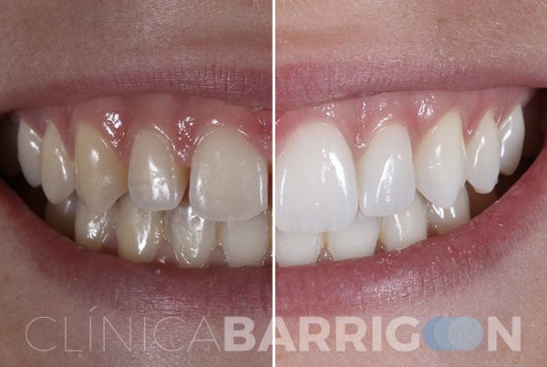 carillas-dentales-valladolid