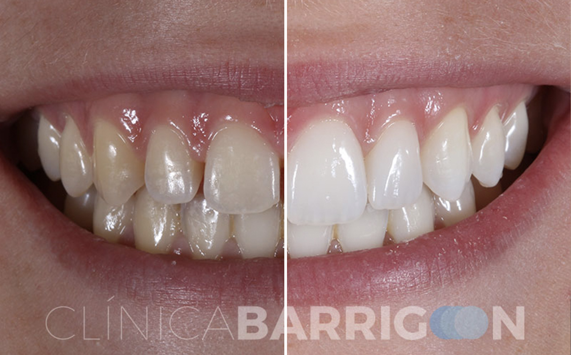 Carillas dentales en Valladolid: porcelana, composite y proceso