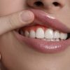 Alt: Gingivectomía dental en Valladolid: remodelado del tejido gingival