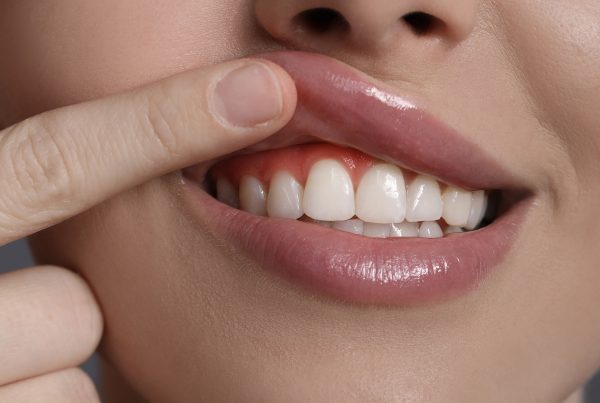 Alt: Gingivectomía dental en Valladolid: remodelado del tejido gingival