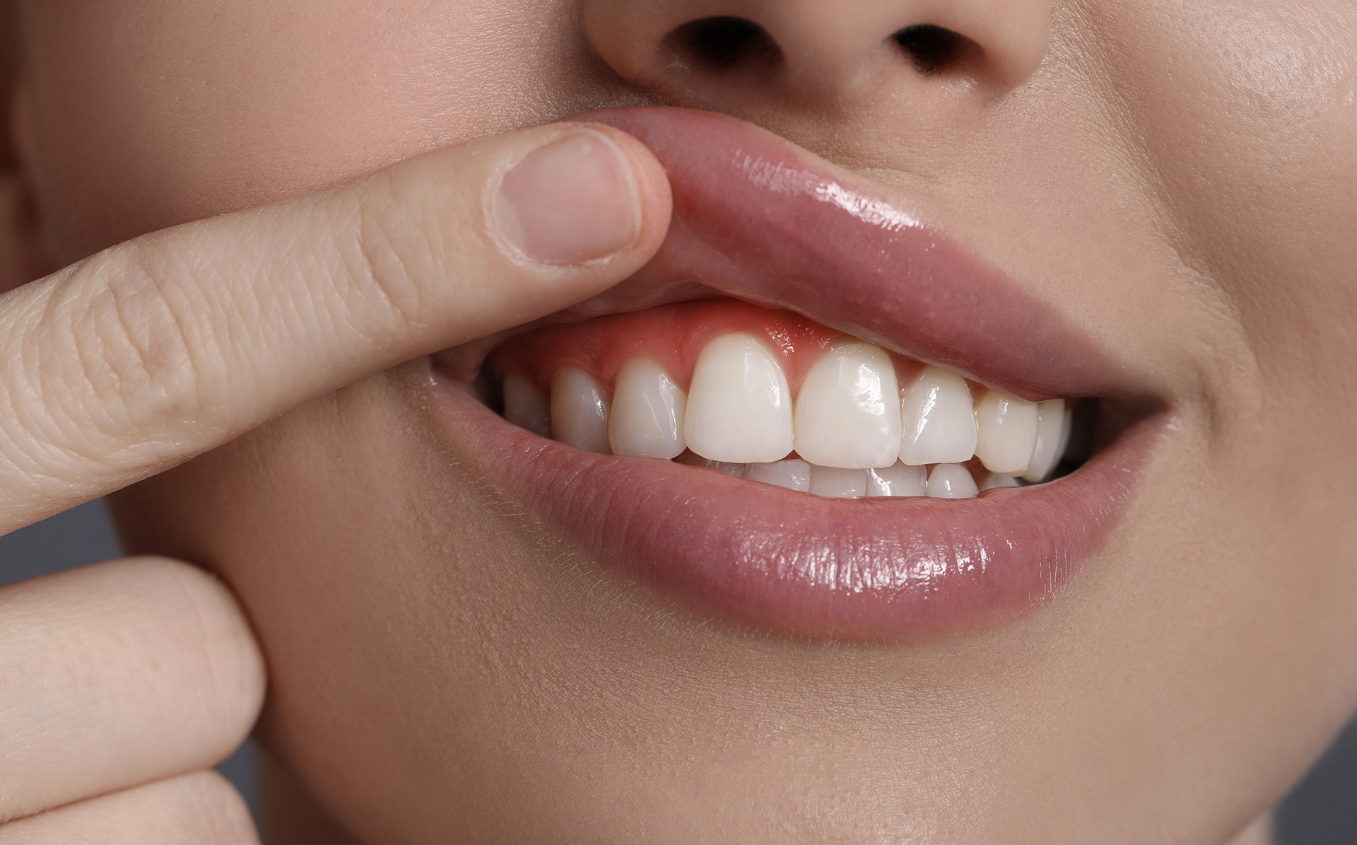 Gingivectomía dental: qué es, cuándo se indica y cómo es el procedimiento