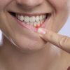 periodoncia-valladolid-encia-inflamada