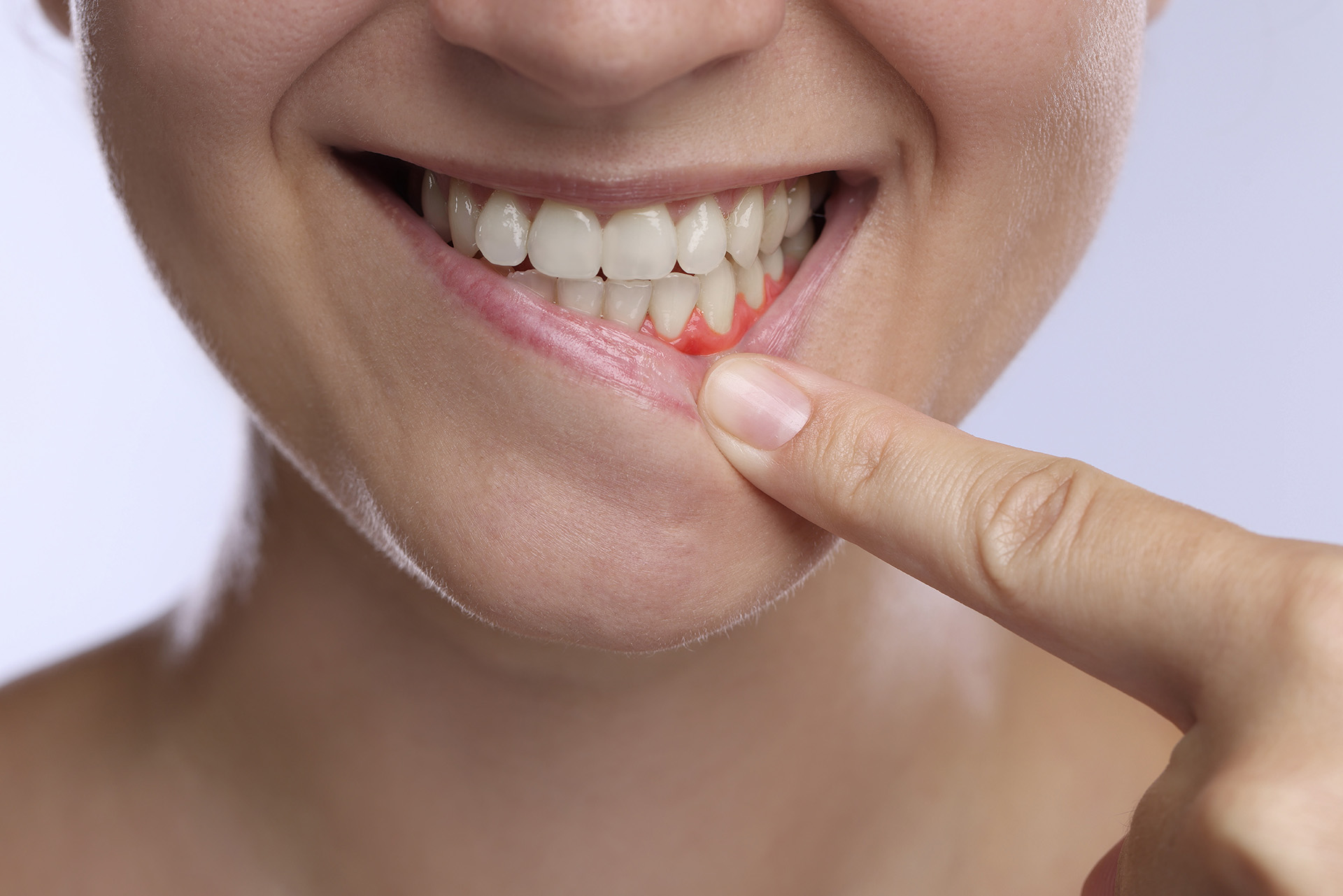 periodoncia-valladolid-encia-inflamada